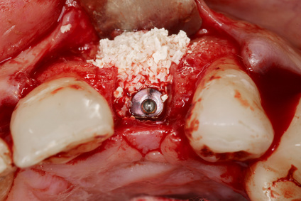 Lateraler Sinuslift im Oberkiefer, Implantat und Knochengranulat [©Jose Magon, fotolia.com]