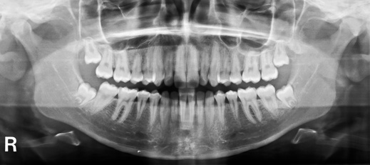 2D-Orthopantomogramm [©Andreas Gruhl, fotolia.com]