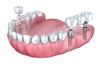 Versorgung einer Freiendsituation mit einer implantatgetragenen Brücke [©Alexandr Mitiuc, fotolia.com]