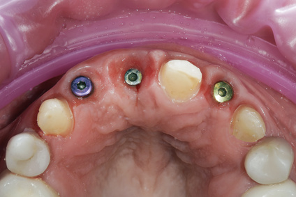 Freigelegte Implantate im Oberkiefer [©DenDor, fotolia.com]