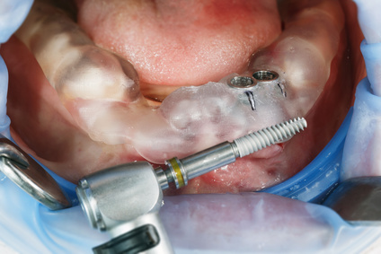Implantation mit Bohrschablone [©DenDor, fotolia.com]