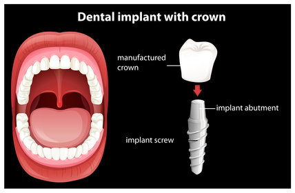 Einteiliges Implantat mit Keramikkrone [©blueringmedia, fotolia.com]