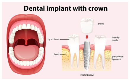 offener Einheilung des einteiligen Implantats wird es durch die Keramikkrone ergänzt. [©blueringmedia, fotolia.com]