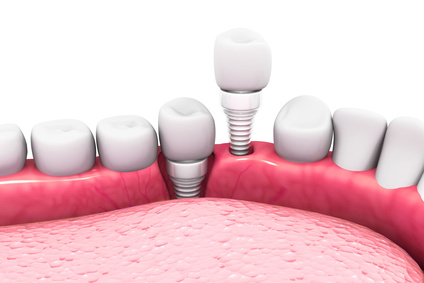 Keramikimplantate mit Einzelkronen [©Crystal light, fotolia.com]