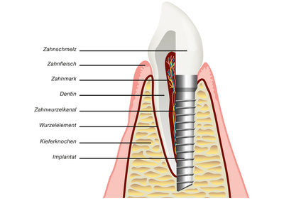 Querschnitt: Natürlicher Zahn und implantatgetragene Krone im Vergleich [©Sven Bähren, Fotolia.com]