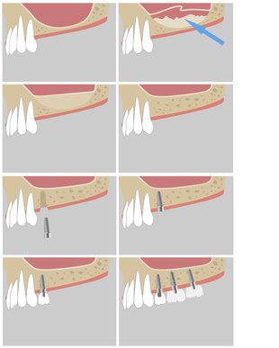 Schema zum lateralen Sinuslift [©Piumadaquila, fotolia.com]